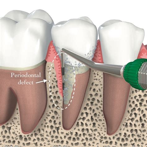 Do periodontal ligaments grow back?