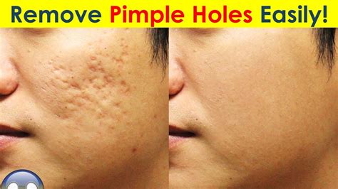 Do pimple holes ever go away?