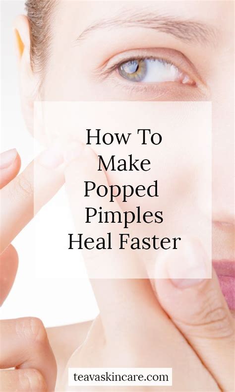 Do pimples heal faster when not popped?