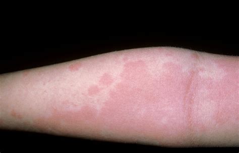 Do rashes disappear when pressed?
