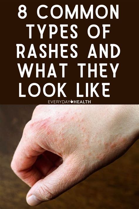Do rashes dry up when healing?
