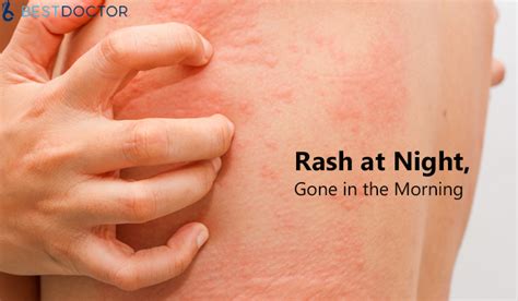 Do rashes get worse at night?