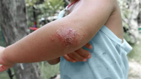Do rashes leave scars?