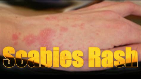 Do rashes spread when you scratch?