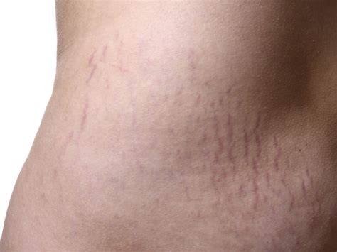 Do red stretch marks mean weight gain?