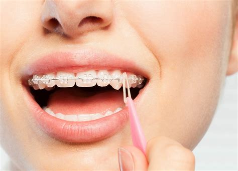 Do rubber bands move your jaw or teeth?