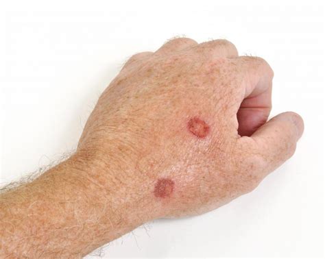Do scabs heal slower as you age?