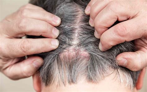 Do scabs on scalp prevent hair growth?