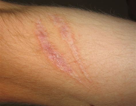 Do scars eventually turn white?