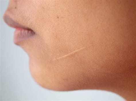 Do scars get lighter over time?