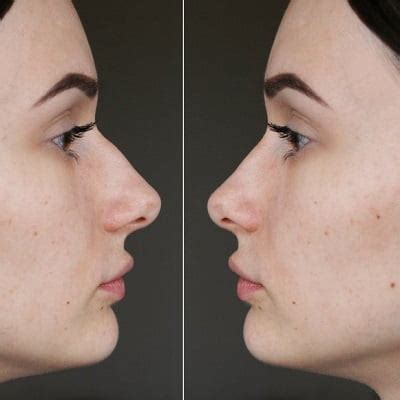 Do septums change your nose shape?