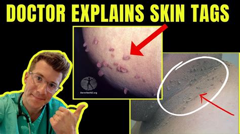 Do skin tags come from being dirty?