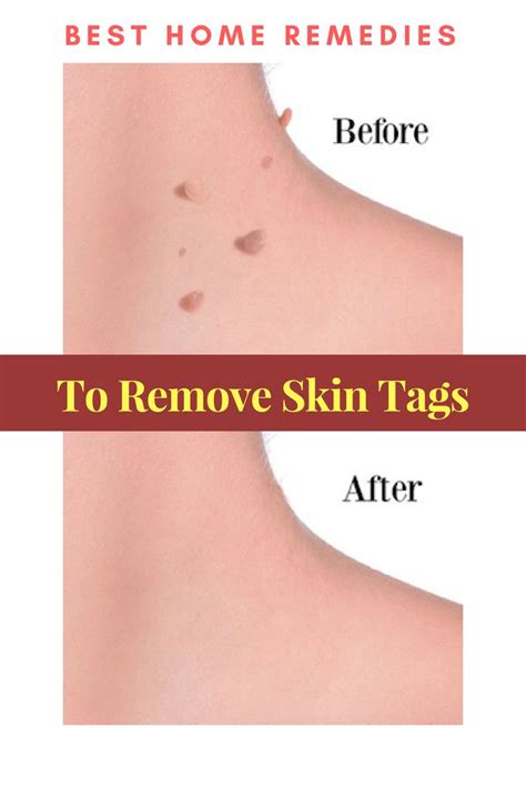 Do skin tags go away automatically?