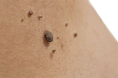 Do skin tags grow back once removed?