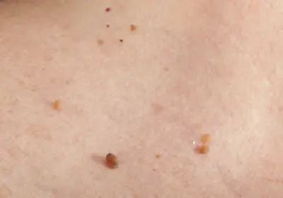 Do skin tags just keep growing?