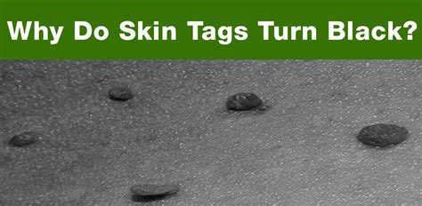 Do skin tags turn black before they fall off?