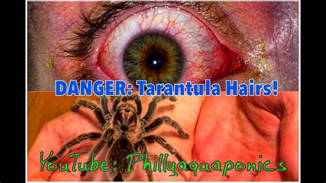 Do spider hairs hurt?