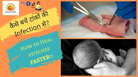 Do stitches after birth make you tighter?