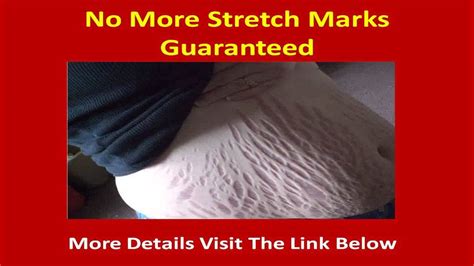 Do stretch marks go away on your breast?