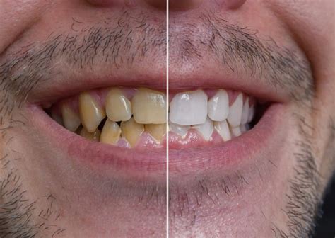 Do teeth repair after smoking?