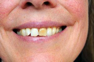 Do teeth stay permanently yellow?