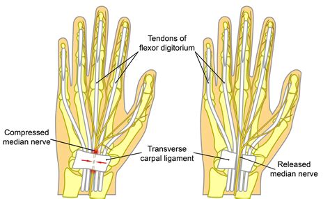 Do they cut the tendon in carpal tunnel surgery?