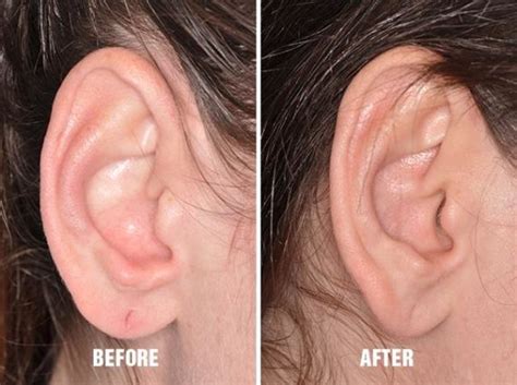 Do they put you to sleep for an earlobe surgery?