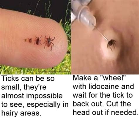 Do ticks live after removed?