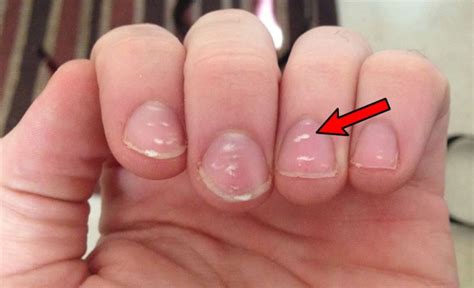 Do white spots on nails mean trauma?