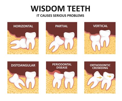 Do wisdom teeth push other teeth?