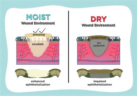Do wounds heal faster when wet or dry?