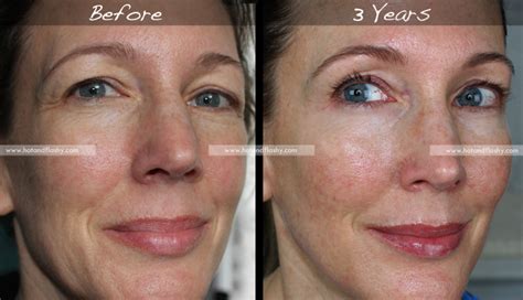 Do wrinkles look worse when starting tretinoin?