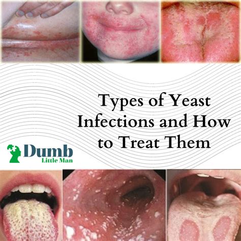 Do yeast infections leave permanent damage?