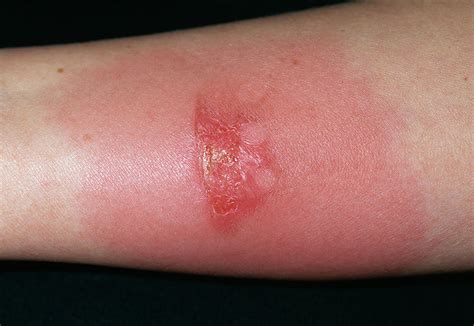 Do you cover an infected burn?
