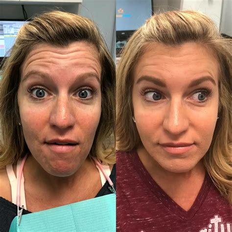 Do you look normal after Botox?
