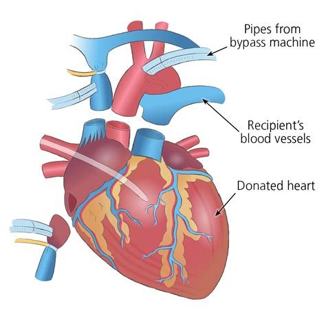 Do you still love the same after a heart transplant?