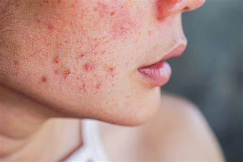 Does ADHD cause skin problems?