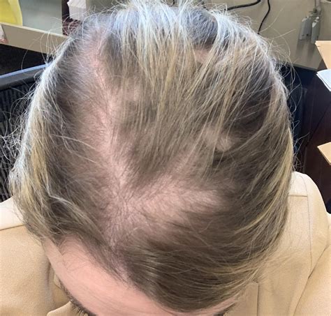 Does Accutane affect hair?