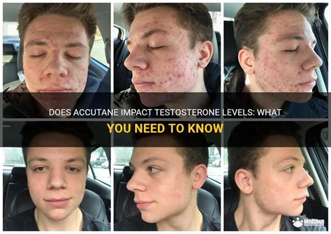 Does Accutane affect testosterone?