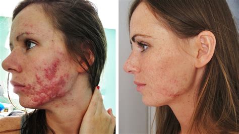 Does Accutane clear skin forever?
