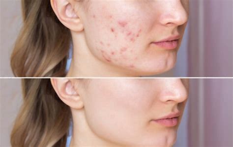 Does Accutane make you gain weight?