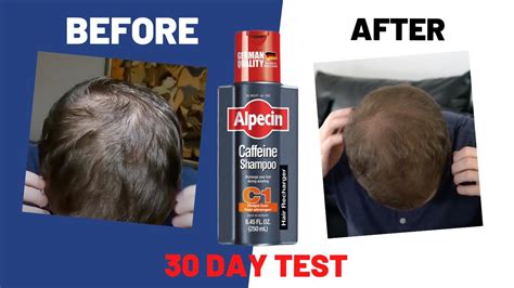 Does Alpecin cause hair growth?