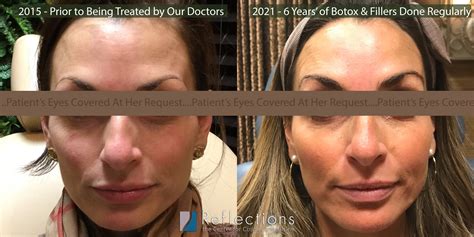 Does Botox age you long term?