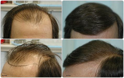 Does Botox cause frontal hair loss?