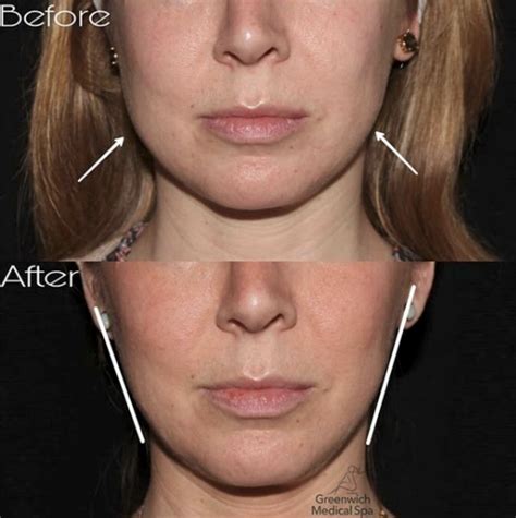 Does Botox damage facial muscles?