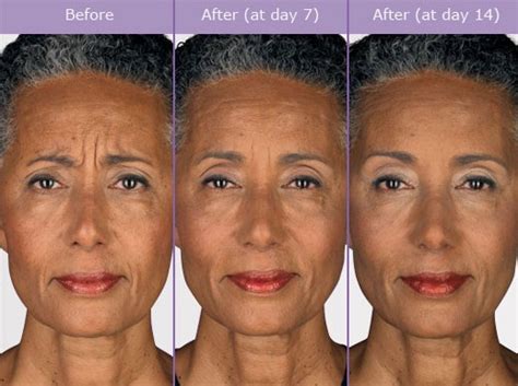 Does Botox eventually age you?