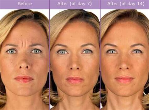 Does Botox ever completely wear off?