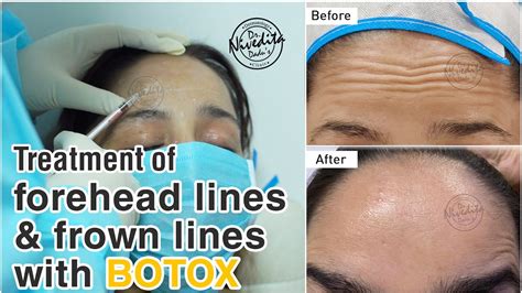 Does Botox give you a smooth forehead?