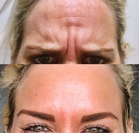 Does Botox in 11s lift brows?