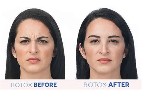 Does Botox reduce empathy?